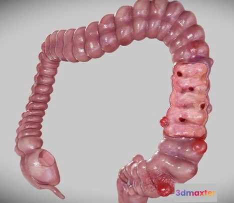 1522882 - PBR Game 3D Models - Diverticulosis And Diverticulitis 3D Max