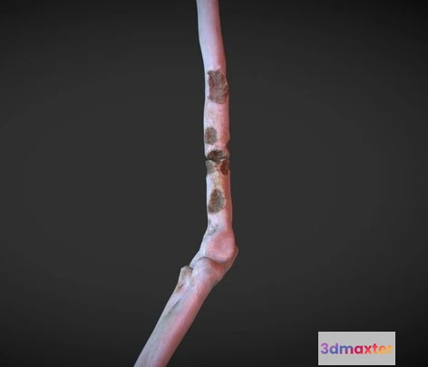 1531938 - PBR Game 3D Models - Arm With Lytic Lesions 3D Max